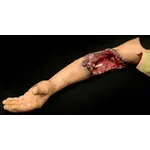 Techline Technologies Partial Left Arm Amputation