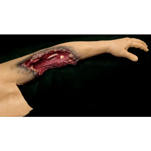 Techline Technologies Partial Left Arm Amputation