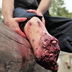 Techline Technologies Full Leg Amputation