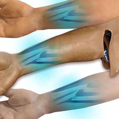 Techline Technologies Closed Right Arm Fracture