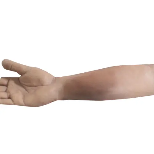 Techline Technologies Closed Right Arm Fracture