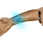 Techline Technologies Closed Right Arm Fracture