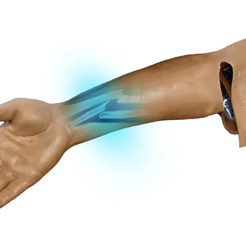 Techline Technologies Closed Right Arm Fracture