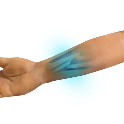 Techline Technologies Closed Right Arm Fracture
