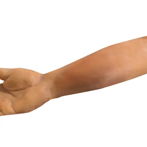 Techline Technologies Closed Right Arm Fracture
