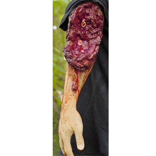 Techline Technologies Partial Right Arm Amputation