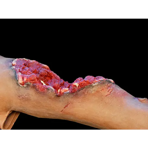 Techline Technologies Partial Right Arm Amputation