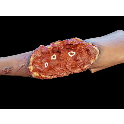 Techline Technologies Partial Right Arm Amputation
