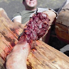 Techline Technologies Partial Right Leg Amputation