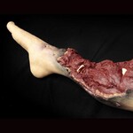 Techline Technologies Partial Right Leg Amputation
