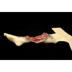 Techline Technologies Partial Right Leg Amputation