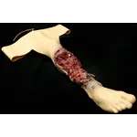 Techline Technologies Partial Right Leg Amputation