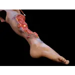 Techline Technologies Partial Right Leg Amputation