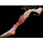 Techline Technologies Partial Right Leg Amputation