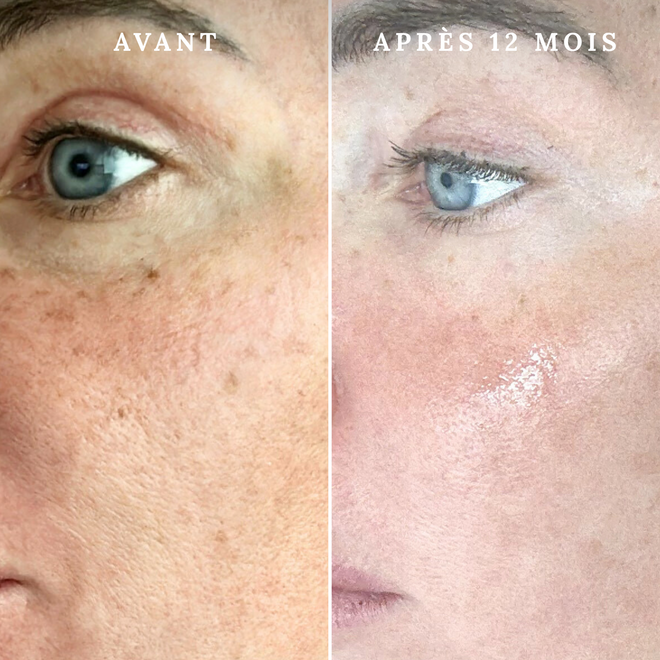 Masque LED pour le visage - Rose