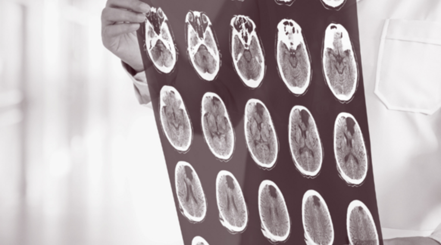 Olive Oil and Dementia: What a 28-Year Study Found About Dementia-Related Death