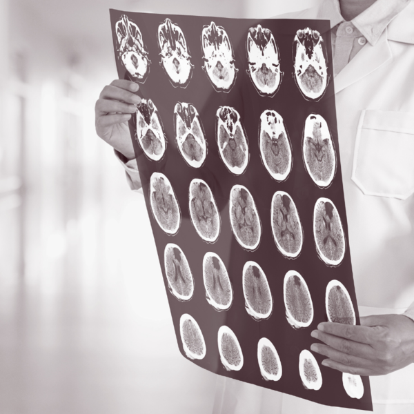 Olive Oil and Dementia: What a 28-Year Study Found About Dementia-Related Death