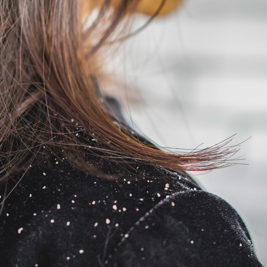 Dandruff control