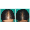 Profesional Cosmetics Profesional Cosmetics PLACENTINOL THINNING HAIR System Kit