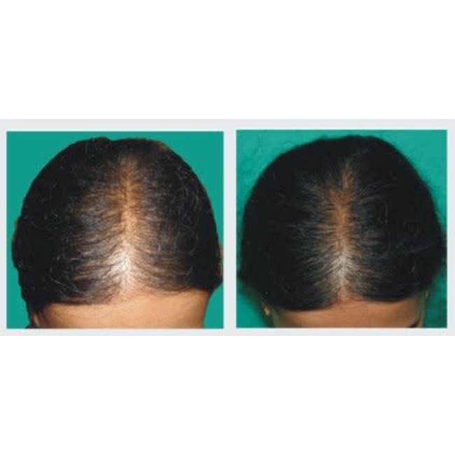 Profesional Cosmetics Profesional Cosmetics PLACENTINOL THINNING HAIR System Kit