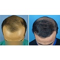 Profesional Cosmetics Profesional Cosmetics PLACENTINOL THINNING HAIR System Kit