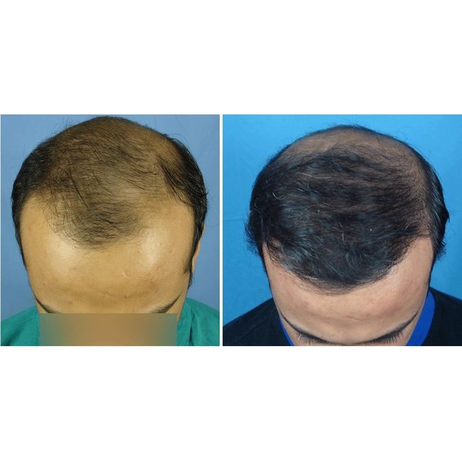 Profesional Cosmetics Profesional Cosmetics PLACENTINOL THINNING HAIR System Kit