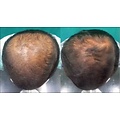 Profesional Cosmetics Profesional Cosmetics PLACENTINOL THINNING HAIR System Kit