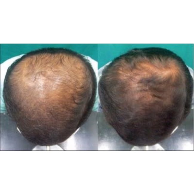 Profesional Cosmetics Profesional Cosmetics PLACENTINOL THINNING HAIR System Kit