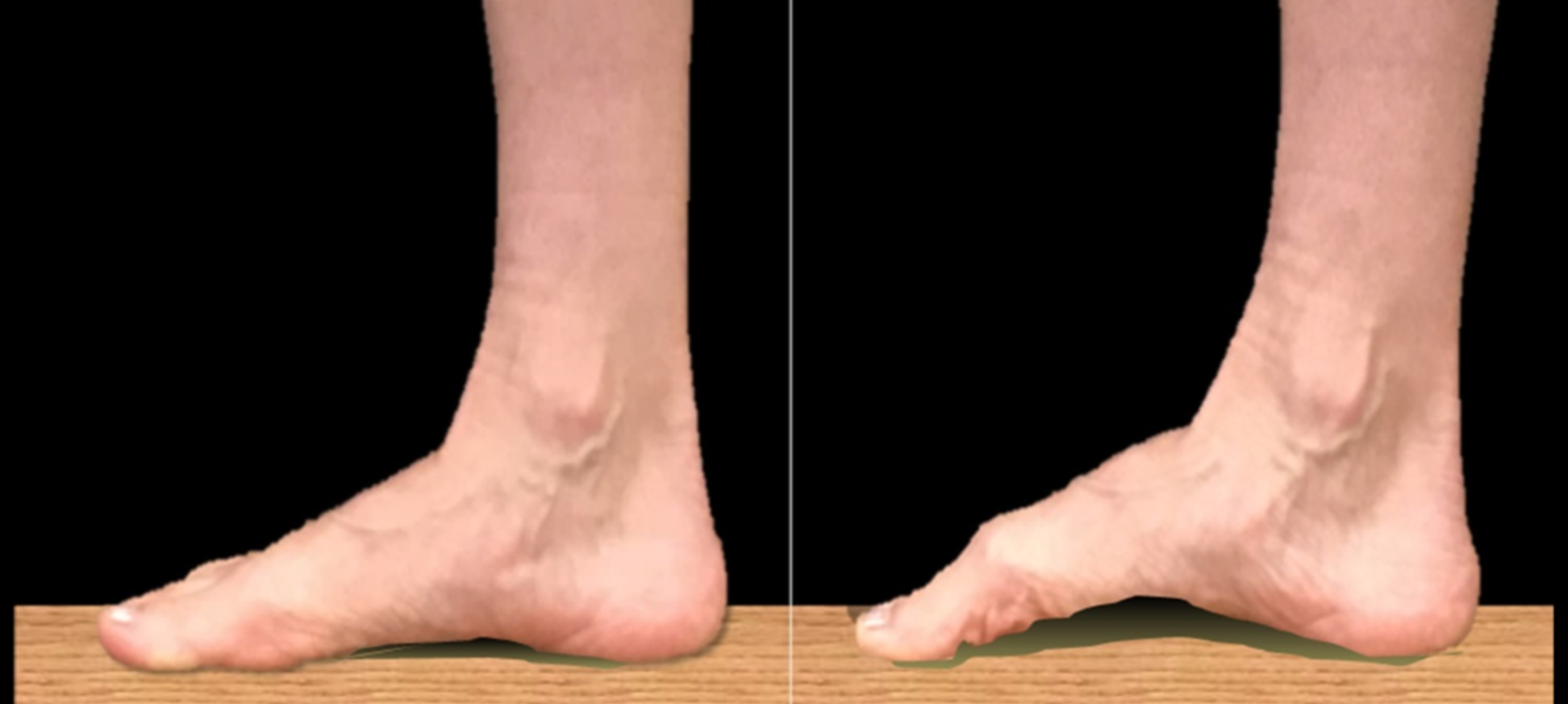 Foot Strength for Walkers and Runners