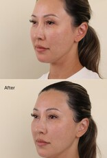 Tetrapeptide Lifting Gel