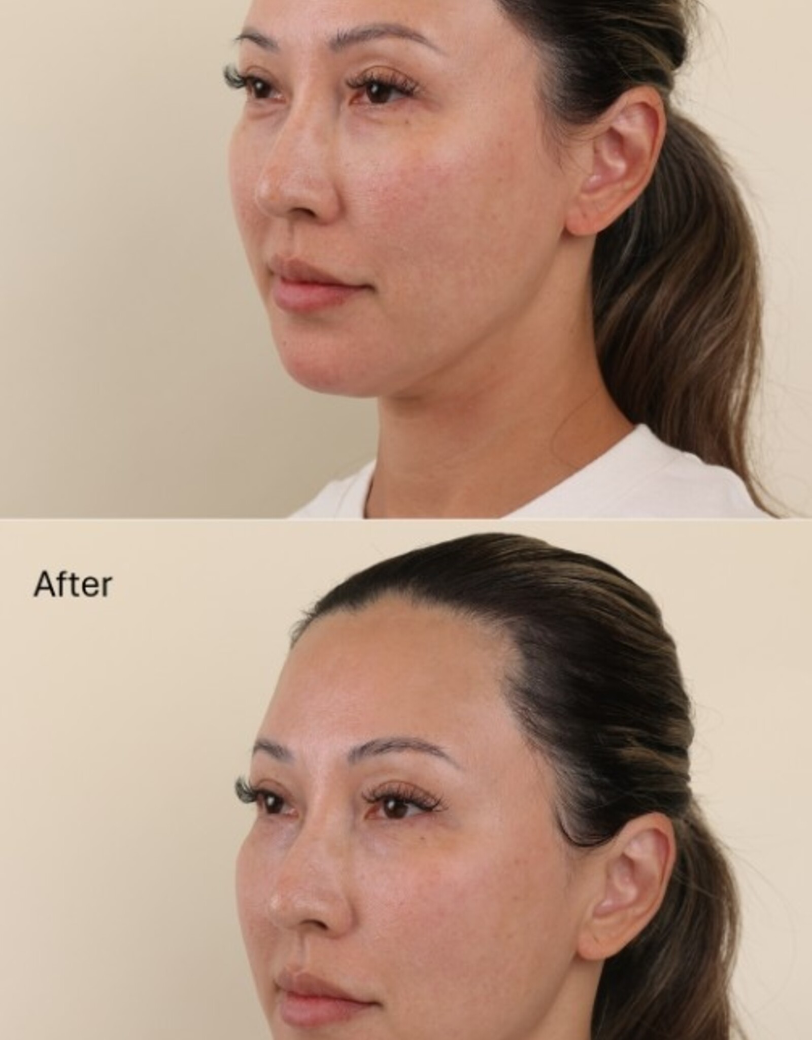 Tetrapeptide Lifting Gel