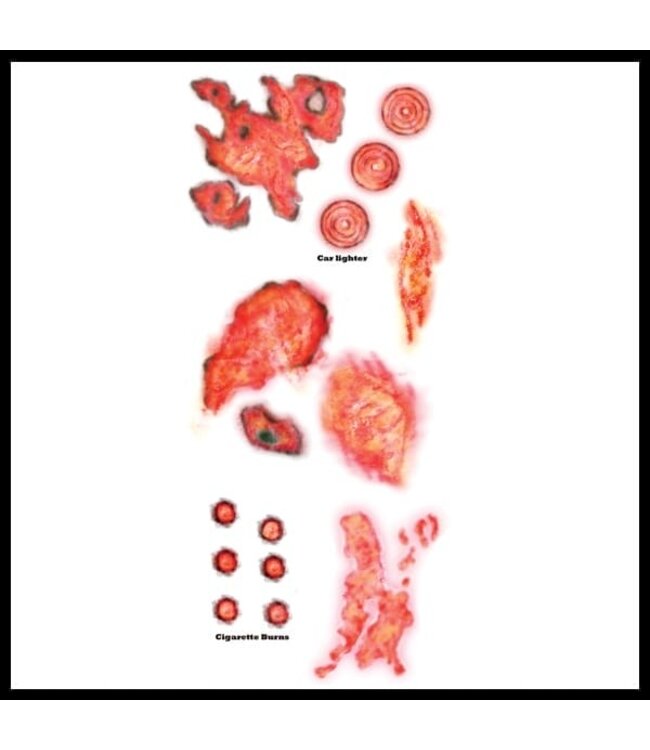 TINSLEY TRANSFERS TRAUMA TAT BURNED ALIVE