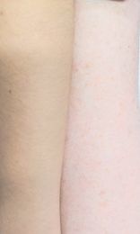 Yellow undertone skin on left, red undertone on right