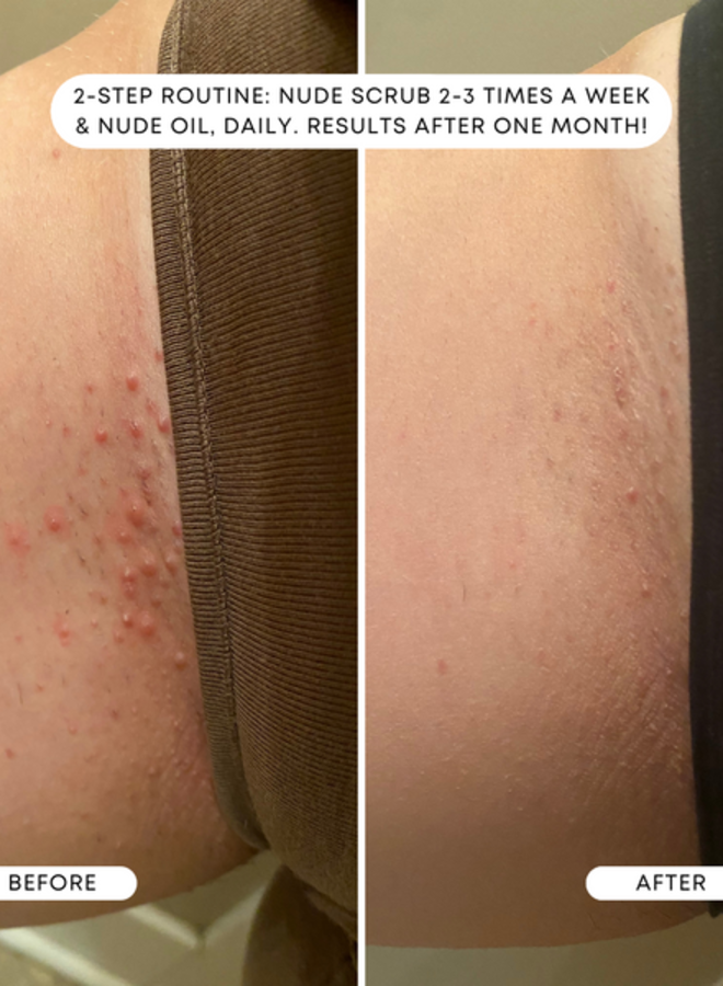 NUDE INGROWN TREATMENT OIL