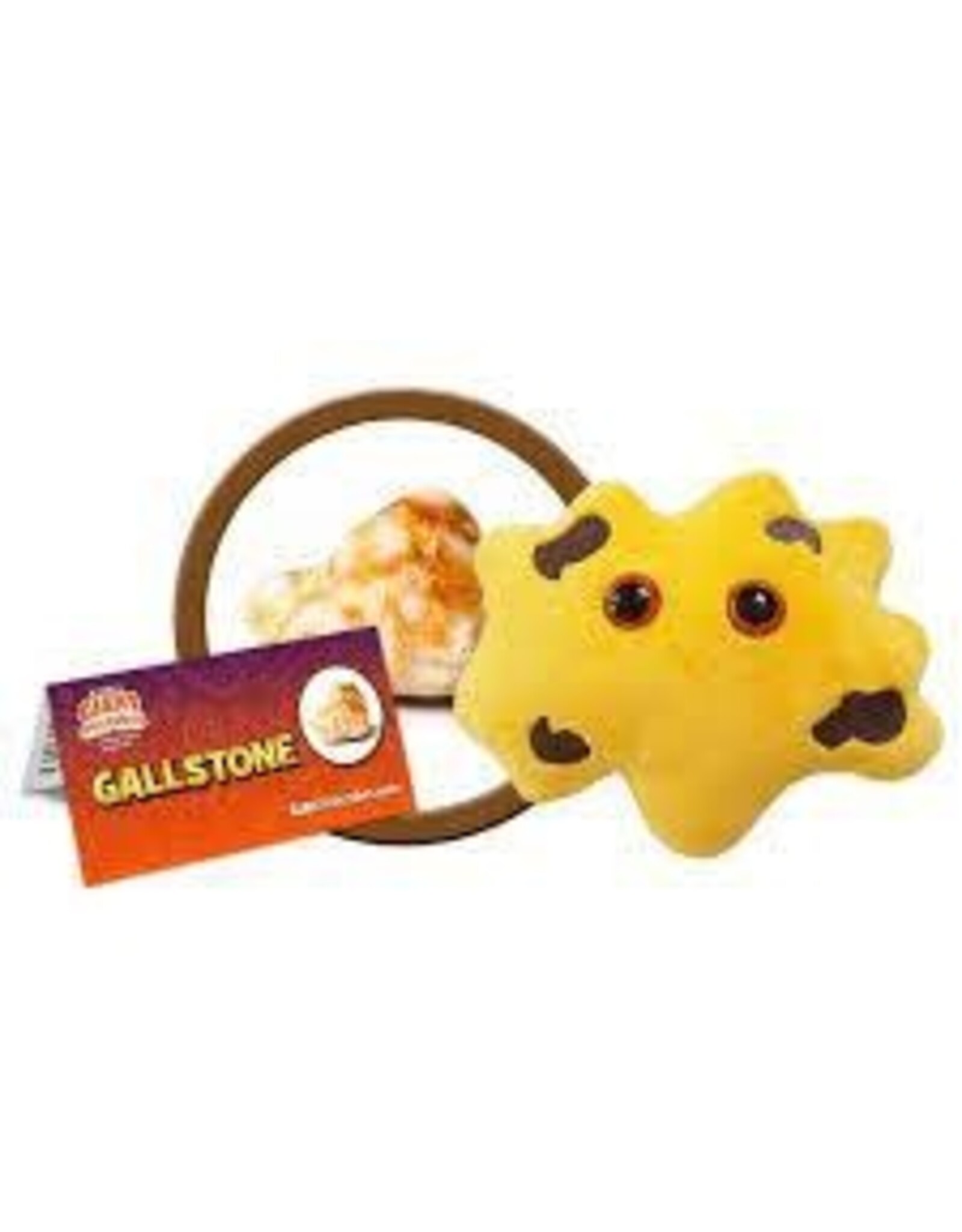 Gallstone