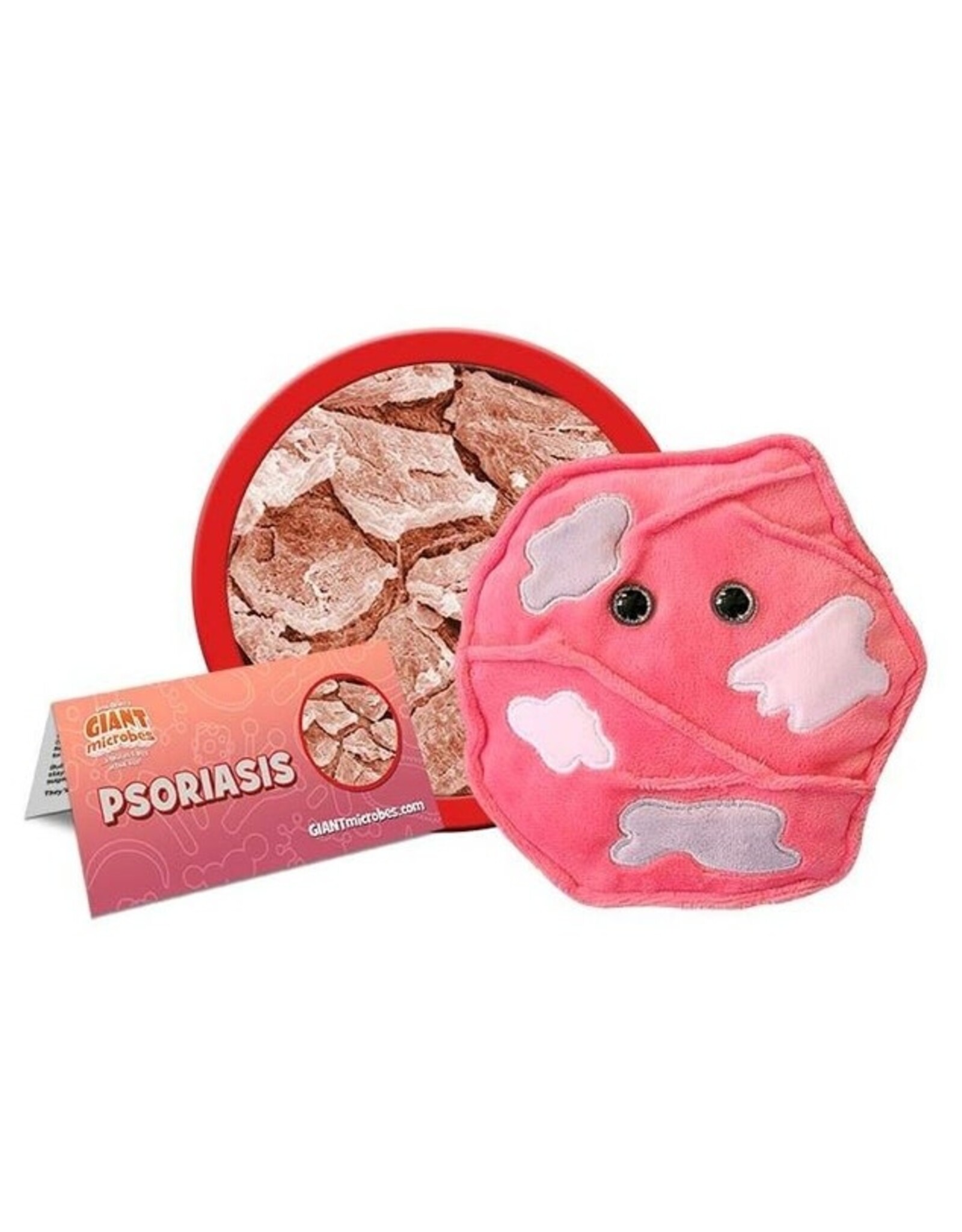 Psoriasis