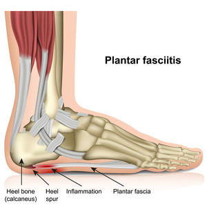 Heel Pain