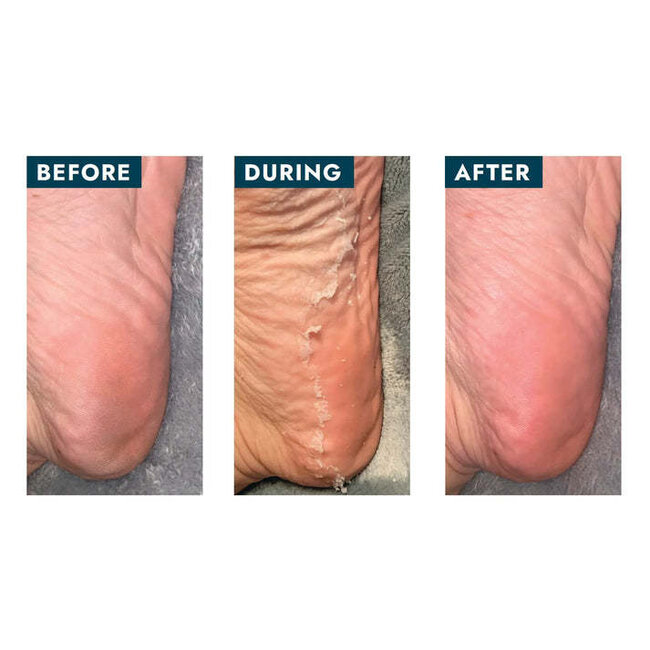 Voesh - Peeling Socks - 1 pair