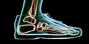 Can Orthotics Have Adverse Effects on Feet?