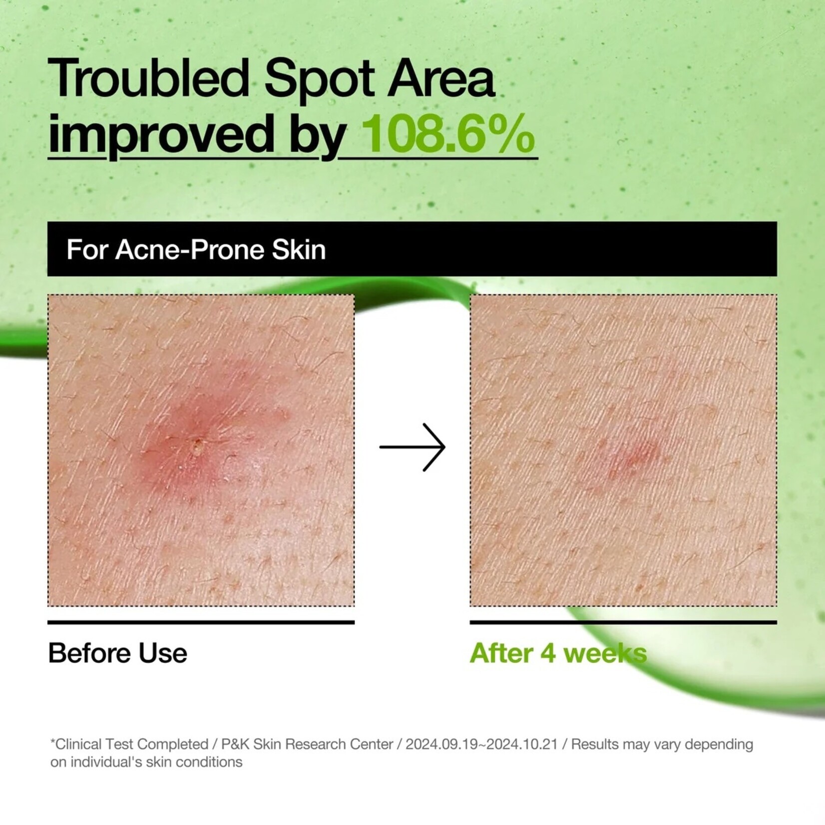 ANUA Azelaic Acid 10 Hyaluron Redness Soothing Serum 30mL
